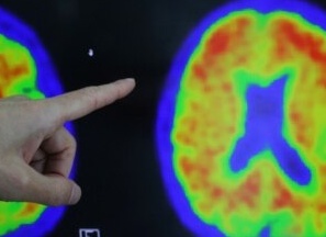 Новый анализ крови поможет выявить болезнь Альцгеймера на ранних стадиях