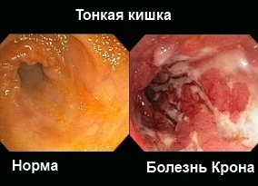 Клинические исследования при болезни Крона и Язвенном колите