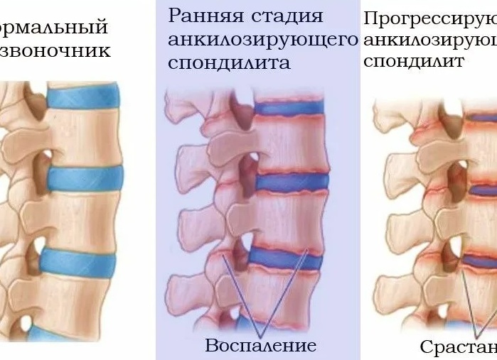 Болезнь Бехчета: симптомы и лечение синдрома, диангностика