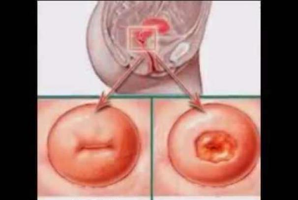 Manifestaciones de ectopia del cuello uterino.