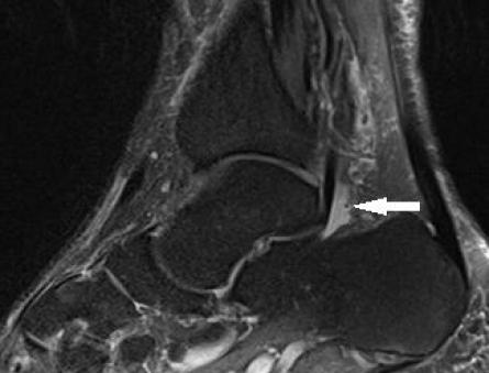 Flexor largo del dedo gordo del sistema nervioso Central - m