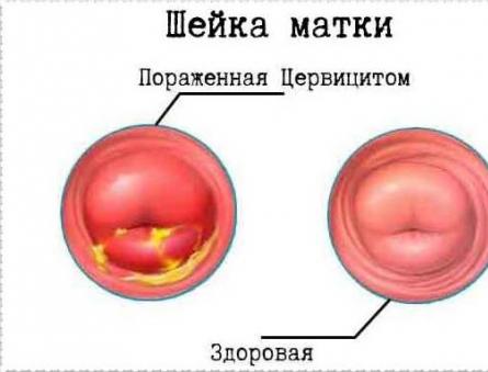 Tratamiento de la cervicitis causada por el VPH El VPH puede causar revisiones de cistitis