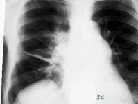 Плеврит на белите дробове: видове заболявания, симптоми и лечение Как да се лекува плеврит на белите дробове
