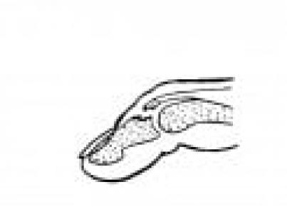 আঙ্গুলের flexor এবং extensor tendons ক্ষতি