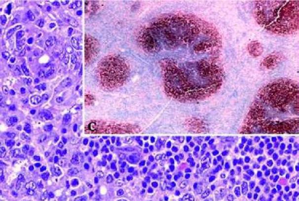 มะเร็งต่อมน้ำเหลือง B-cell คืออะไรและจะรักษาอย่างไร B-cell lymphoma ICD code 10